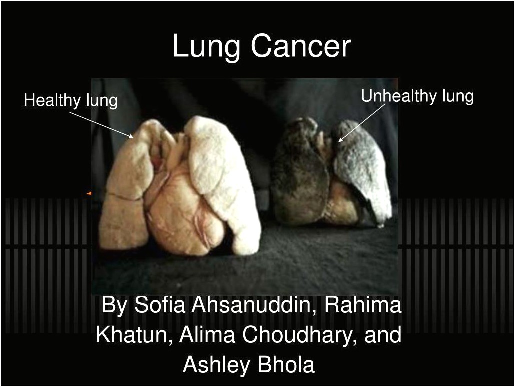 Lung Cancer Ppt Templates Free Download